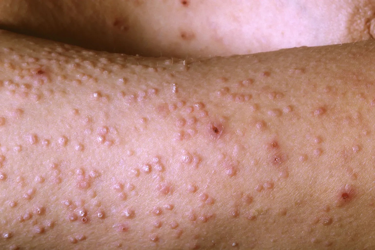 1800x1200_medicalimages_rm_amyloidosis_bigbead